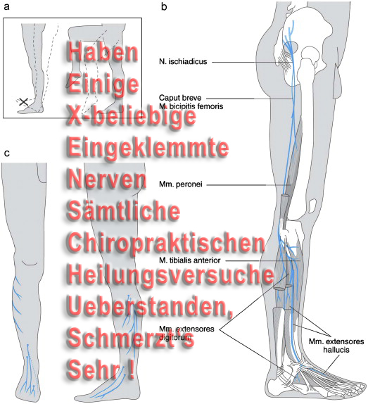 Hexenschuss